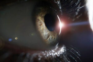 Read more about the article Laser Eye Surgery and Age: What You Need to Know